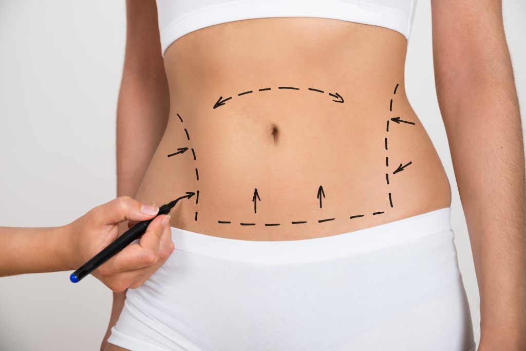 Tummy Tuck Negligence Claims – How Much Compensation Could I Claim