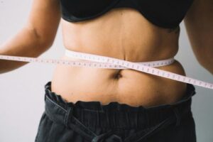 Tummy Tuck Gone Wrong - Claiming Compensation