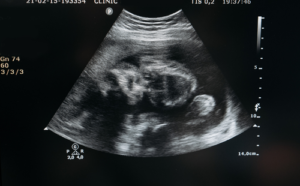 NHS Maternity Negligence Has Reached a crisis point - Your family has rights