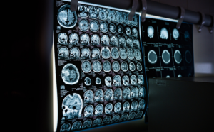 Serious Injury Claims - What you need to know